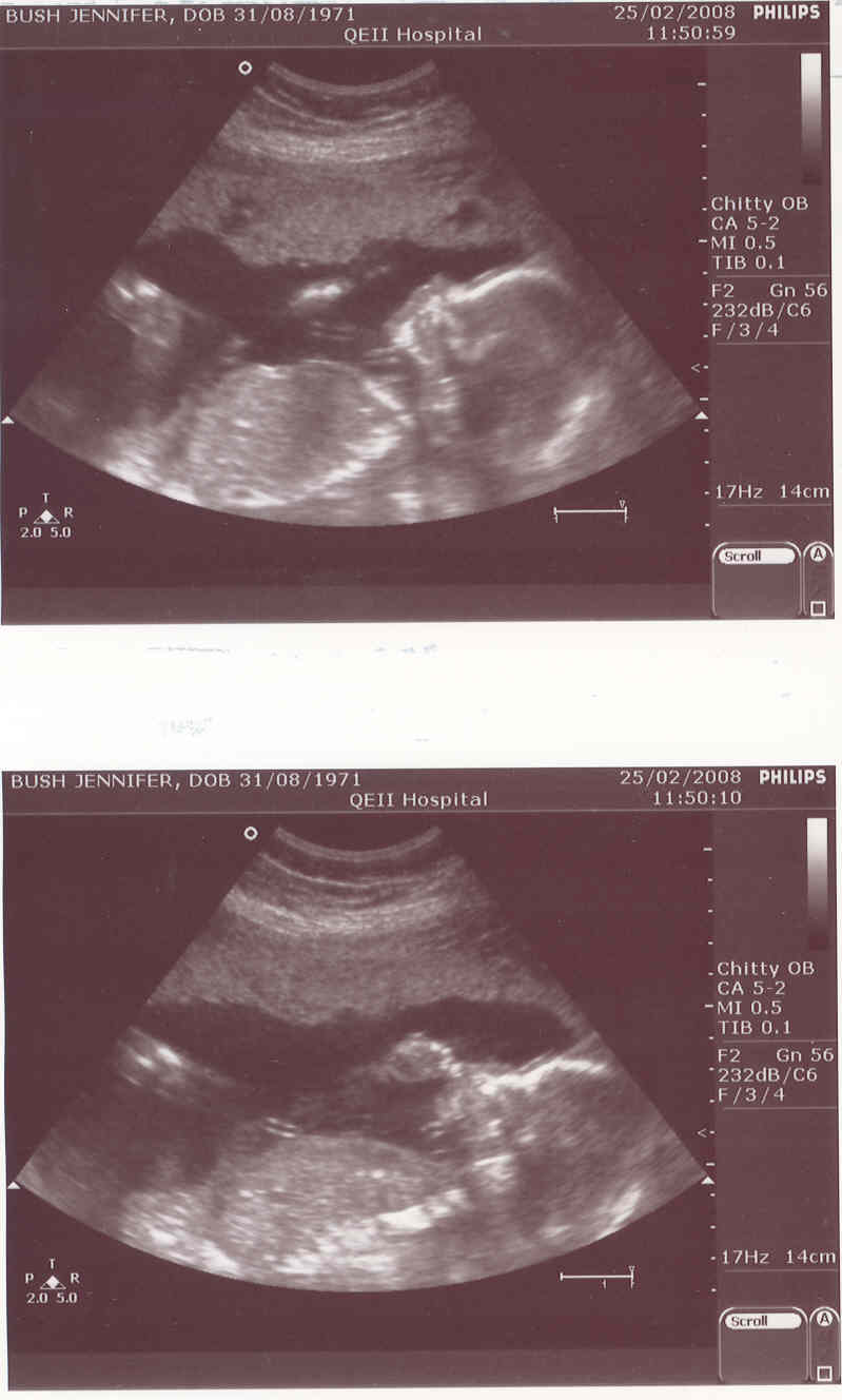 baby scan girl
